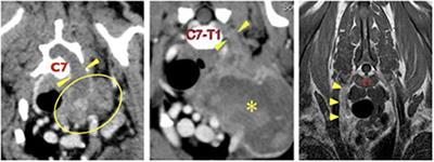 Case Report: A Novel Lateral Approach to the C7, C8, and T1 Intervertebral Foramina for Resection of Malignant Peripheral Nerve Sheath Neoplasia, Followed by Adjunctive Radiotherapy, in Three Dogs